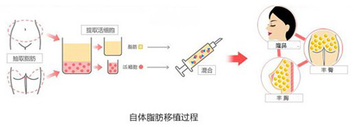 自体脂肪注射隆鼻