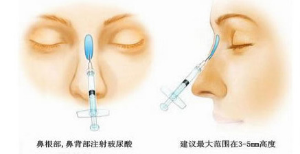 自体脂肪注射隆鼻