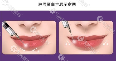 胶原蛋白丰唇