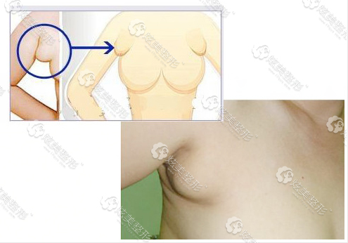 副乳