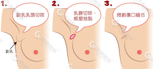 副乳切除