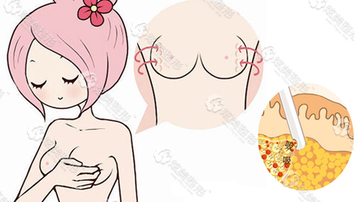 副乳吸脂