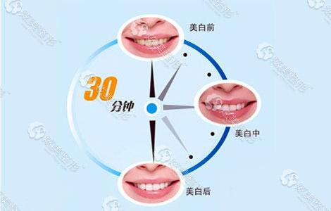 冷光美白牙齿