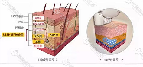 除皱原理