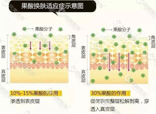 果酸换肤示意图