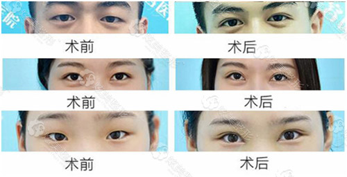 杨权明双眼皮整形案例 杨权明双眼皮整形案例