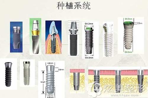 种植牙系统多样化,国产进口各不相同 种植牙系统多样化,国产进口各不相同