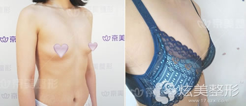 北京京美刘成胜医生自体脂肪隆胸成功案例 北京京美刘成胜医生自体脂肪隆胸成功案例