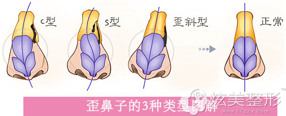 ����ӷ�ΪC�͡�S�͡�б��������