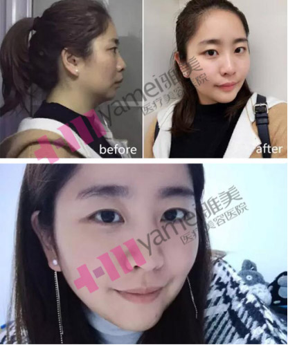 长沙雅美下巴整形前后<span style= 长沙雅美下巴整形前后<span style=