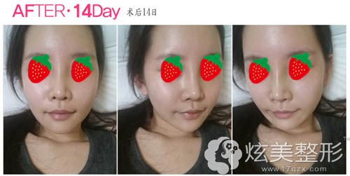术后14天隆鼻还未消肿 术后14天隆鼻还未消肿