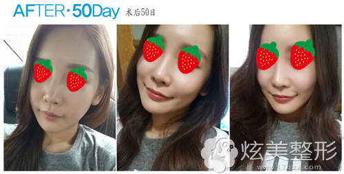 脂肪移植+鼻子整形术后50天 脂肪移植+鼻子整形术后50天