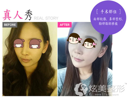 脂肪移植+鼻部整形术前术后对比案例 脂肪移植+鼻部整形术前术后对比案例