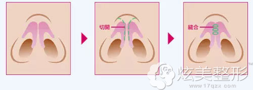 鼻软骨形态异常导致鼻翼肥大鼻整形手术原理 鼻软骨形态异常导致鼻翼肥大鼻整形手术原理