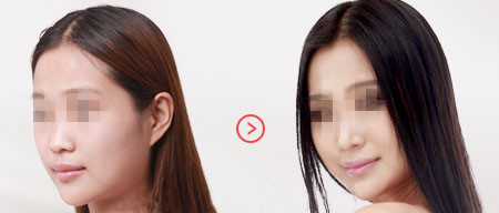 去中妍做完隆鼻手术前后的对比 去中妍做完隆鼻手术前后的对比