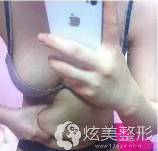 腰腹部吸脂手术前大肚腩 腰腹部吸脂手术前大肚腩