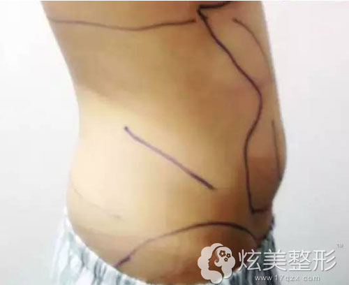 吸脂术前腰腹部画线 吸脂术前腰腹部画线