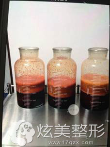案例腰腹部吸脂抽出的脂肪 案例腰腹部吸脂抽出的脂肪