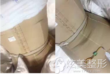 塑身衣案例腰腹部吸脂 塑身衣案例腰腹部吸脂