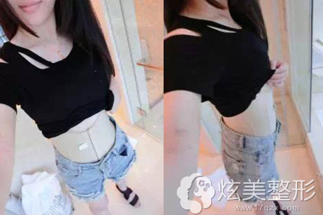 术后塑身衣案例图 术后塑身衣案例图
