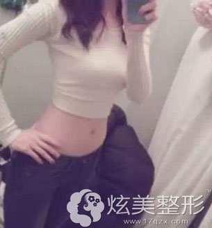 手术成功后小蛮腰案例图 手术后成功小蛮腰案例图