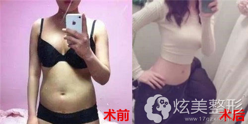 腰腹部吸脂成功前后对比图 腰腹部吸脂成功前后对比图