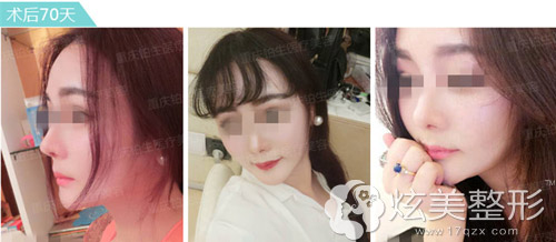 杜亚旭隆鼻失败修复术后70天 杜亚旭隆鼻失败修复术后70天