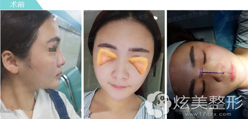 重庆铂生隆鼻失败修复前样子 重庆铂生隆鼻失败修复前样子