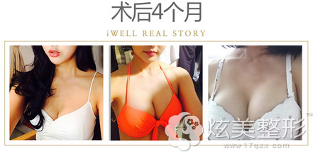 隆胸术后四个月,韩国爱我微毛面隆胸假体效果自然,手感真实 隆胸术后四个月,韩国爱我微毛面隆胸假体效果自然,手感真实