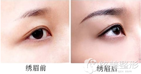郑州欧兰医疗美容医院绣眉前后对比 郑州欧兰医疗美容医院绣眉前后对比
