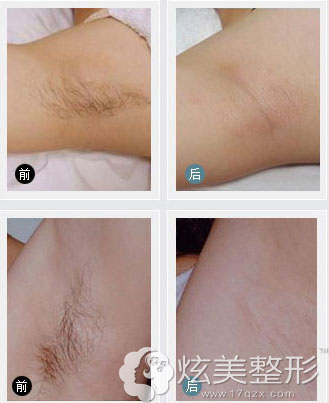 中山美南华脱腋毛案例图 中山美南华脱腋毛案例图