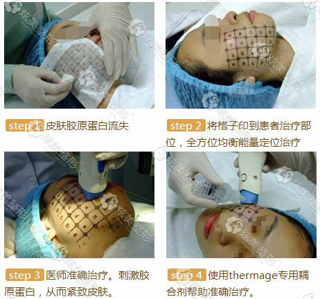 热玛吉除皱手术过程图 热玛吉除皱手术过程图
