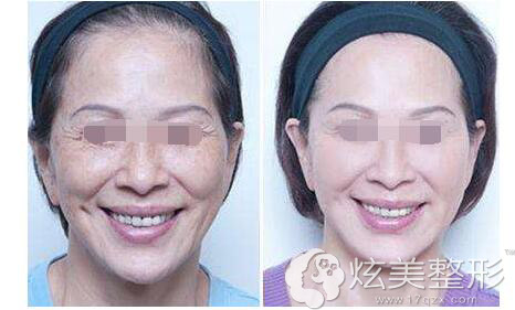 热玛吉除皱对比案例 热玛吉除皱对比案例