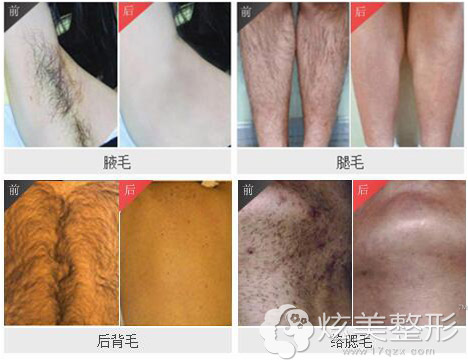 昆山百达丽脱毛整形案例 昆山百达丽脱毛整形案例