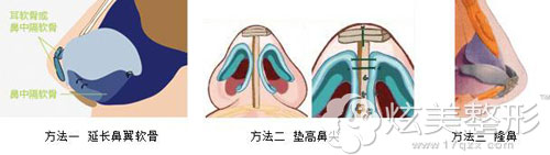 医美整形朝天鼻矫正三种方法 医美整形朝天鼻矫正三种方法