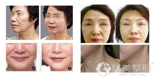 深圳南方激光美容整形医院黄晓华医生术前后对比 深圳南方激光美容整形医院黄晓华医生术前后对比