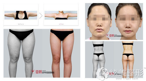 林彪斌医生吸脂塑形术前后对比 林彪斌医生吸脂塑形术前后对比