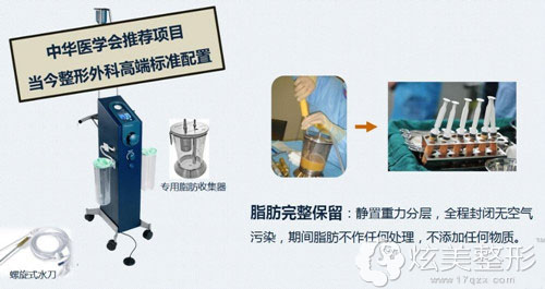 jet水动力吸脂紧肤术采用的高端仪器进行吸脂手术 jet水动力吸脂紧肤术采用的高端仪器进行吸脂手术