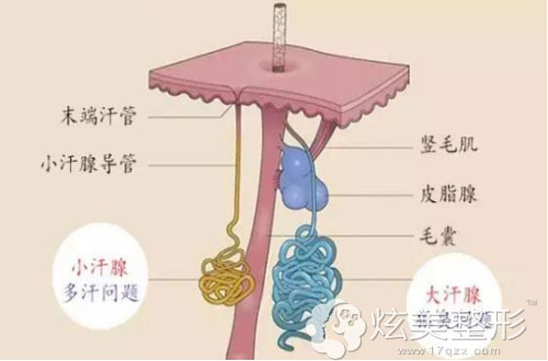 人体内大汗腺导致分泌狐臭 人体内大汗腺导致分泌狐臭