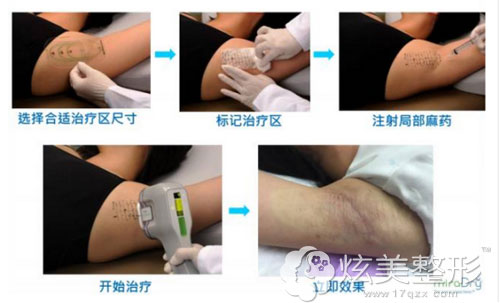 昆明华美美莱除腋臭治疗过程分5步 昆明华美美莱除腋臭治疗过程分5步