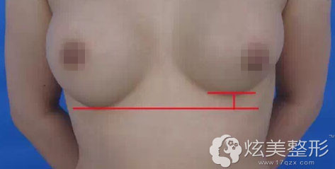 隆胸失败乳房的异常形态 隆胸失败乳房的异常形态