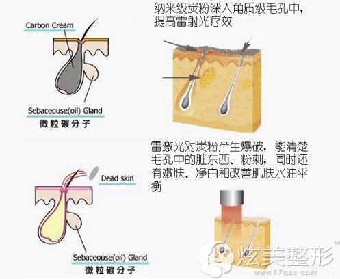 黑脸娃娃美白原理图 黑脸娃娃美白原理图
