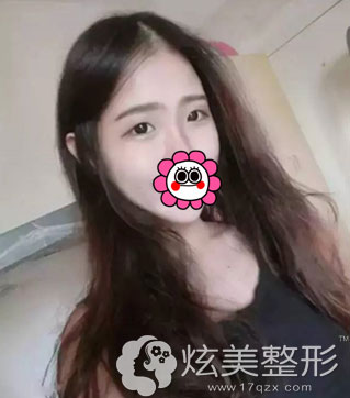 珠海莱茵双眼皮手术术前照 珠海莱茵双眼皮手术术前照