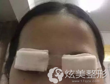 刚下埋线双眼皮手术珠海莱茵整形案例 刚下埋线双眼皮手术珠海莱茵整形案例