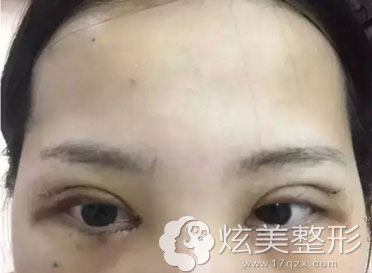 珠海莱茵整形埋线双眼皮案例手术第二天 珠海莱茵整形埋线双眼皮案例手术第二天