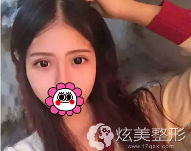 术后半个月双眼皮手术案例珠海莱茵整形 术后半个月双眼皮手术案例珠海莱茵整形