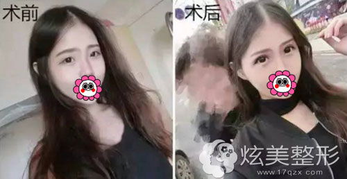珠海莱茵整形医院埋线双眼皮手术真人案例对比图 珠海莱茵整形医院埋线双眼皮手术真人案例对比图