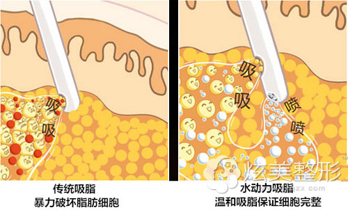 水动力吸脂保持脂肪细胞的完整性 水动力吸脂保持脂肪细胞的完整性