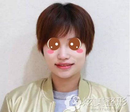 冷光美白案例术前图南京康美整形医院 冷光美白案例术前图南京康美整形医院