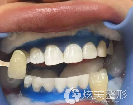 冷光美白术后牙齿白了一个度 冷光美白术后牙齿白了一个度